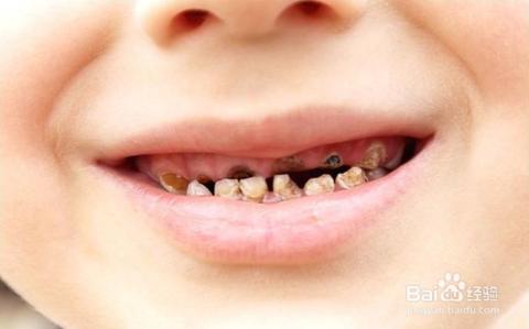 怎么预防龋齿炎 牙龈肿痛如何预防
