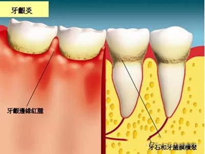 牙龈肿痛怎么快速消肿 为什么会牙龈肿痛