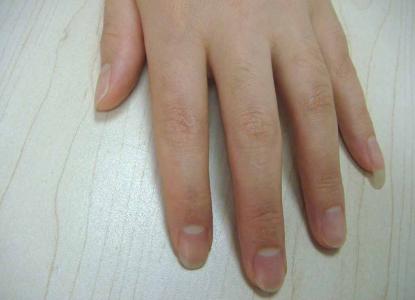 指甲半月板与健康 指甲半月提示人体健康状况