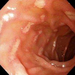 胃癌的症状是什么 胃炎的症状是什么
