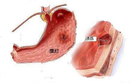 胃糜烂吃什么食物好 胃糜烂吃什么食物比较好