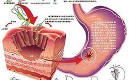 胃粘膜受损吃什么食物 胃黏膜受损吃什么