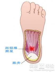 右脚脚后跟疼怎么回事 脚后跟疼是怎么回事怎么办