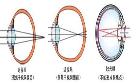 眼睛远视是怎么形成的 远视是怎么形成的