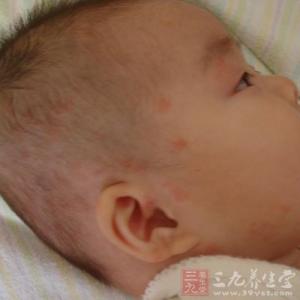 新生儿湿疹怎么治疗 新生儿得了湿疹怎么办 新生儿得湿疹的原因以及治疗办法