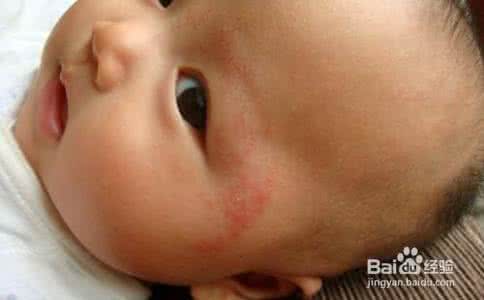 两个月婴儿湿疹怎么办 两个月天婴儿得了湿疹怎么办？
