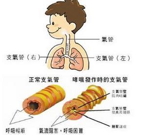 支气管哮喘吃什么食物 支气管哮喘吃什么好_支气管哮喘病人宜吃的食物