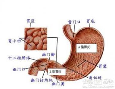 肠胃炎的原因 肠胃炎形成的原因