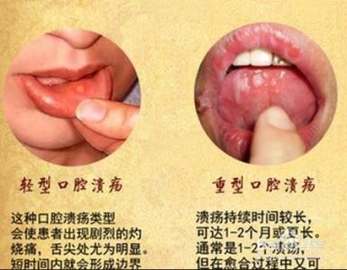 口腔溃疡的治疗方法 两个妙方治口腔溃疡