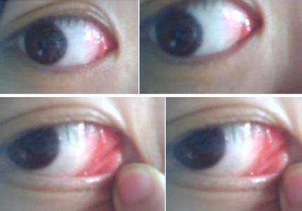 右眼红肿充血怎么回事 眼睛充血红肿怎么办