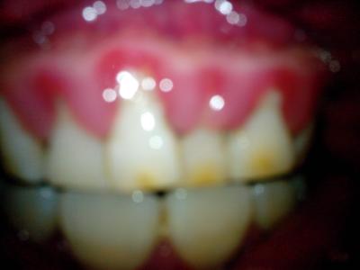 牙龈出血不能吃什么 牙龈出血要吃什么 牙龈出血能吃什么