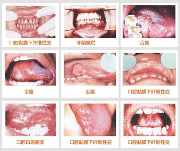 牙龈肿痛吃什么食物 牙龈肿痛患者不能吃什么食物