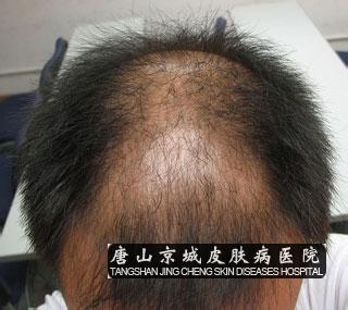 脂溢性脱发怎么治疗 脂溢性脱发治得好吗 脂溢性脱发怎么治疗