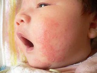治疗幼儿湿疹的偏方 婴儿湿疹的偏方