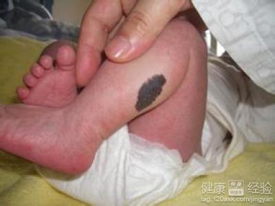 宝宝胎记怎么形成的 宝宝的胎记是怎样形成的 宝宝的胎记的类别