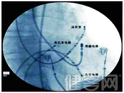 肺结核球的治疗方法 肺结核球是怎么形成的