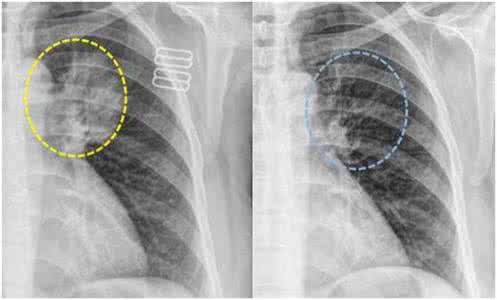 肺部结节是怎么引起的 肺部结节是怎么形成的