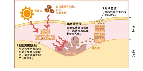 色斑是怎样产生的 色斑是怎样形成的