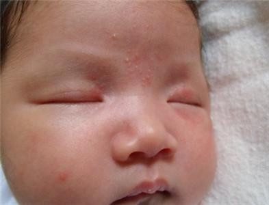 湿疹饮食注意事项 宝宝湿疹怎么形成的 宝宝湿疹的症状与饮食注意