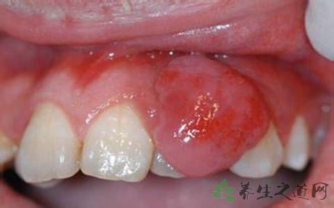 牙龈肿痛吃什么中药 牙龈肿吃什么中药 牙龈肿适合的中药