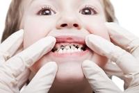 幼儿乳牙蛀牙怎么办 儿童乳牙蛀牙怎么办