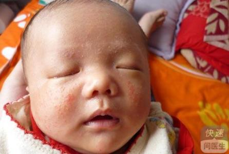 宝宝 湿疹 患处发热 为何宝宝会患上湿疹
