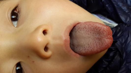 15天新生儿流鼻涕鼻塞 新生儿鼻涕鼻塞怎么办 新生儿鼻涕鼻塞治疗方法