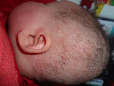 婴儿湿疹最佳治疗方法 婴儿湿疹的原因及治疗方法
