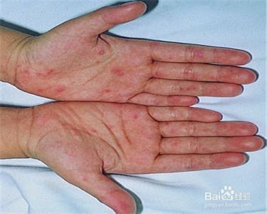 手足口病是什么病毒 手足口病是什么传染病