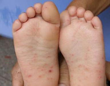 手足口病疫苗 4岁 4种病与手足口病极为相似