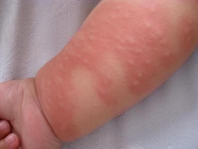什么原因引起幼儿急疹 引发幼儿急疹的原因