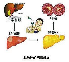 引起脂肪肝的原因 哪些原因可以引起脂肪肝