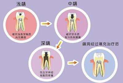 龋齿形成原因 小孩龋齿形成的原因_小孩龋齿是怎么形成的