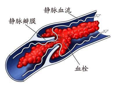 血栓的类型有哪些 血栓形成的条件有哪些