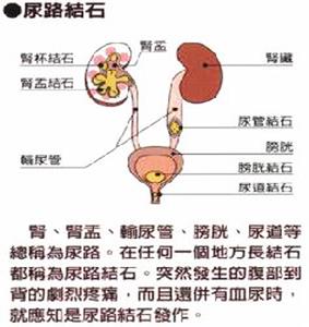 尿结石的早期症状 尿结石有哪些症状 尿道结石的早期症状