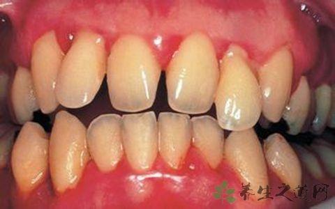 牙龈发炎吃什么食物 调理牙龈发炎的食物推荐