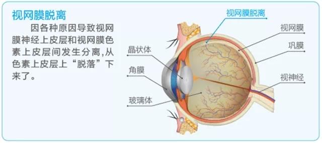 视网膜脱落什么原因 什么原因可引起视网膜脱落
