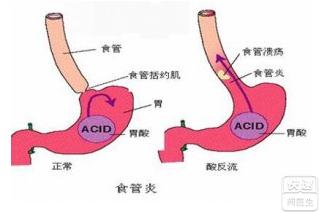 胃酸反流及食道炎 胃酸反流食道炎吃什么好