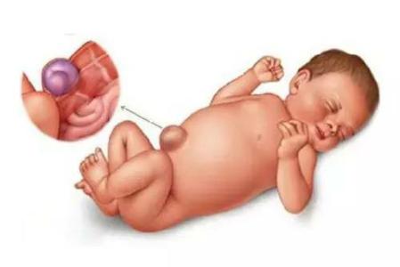 宝宝肚脐突出怎么办 宝宝的肚脐为什么是突出的