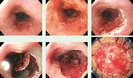 食道癌的早期症状 食管癌如何治疗 食道癌的早期症状