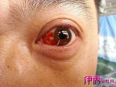 中医眼科眼底病 眼病有哪些 眼睛疾病有哪些 眼科疾病有哪些