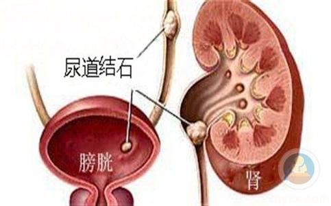 尿道结石的危害 尿道结石有什么危害 尿道结石如何预防