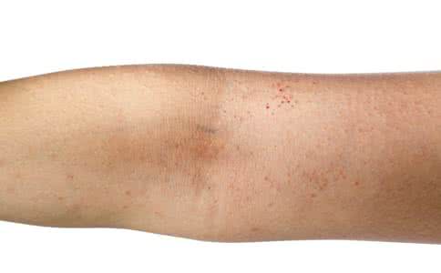 夏季皮肤瘙痒的原因 夏季皮肤瘙痒的原因_皮肤瘙痒怎么办