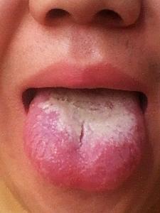 舌苔厚白治疗方法 舌苔发白的原因及治疗方法