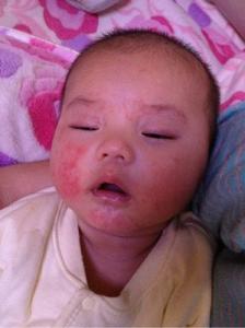 六个月宝宝湿疹图片 6个月宝宝湿疹怎么办
