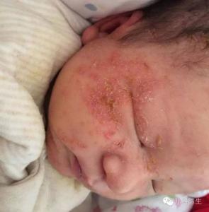 婴幼儿湿疹如何止痒 婴幼儿湿疹与成人湿疹如何来改善