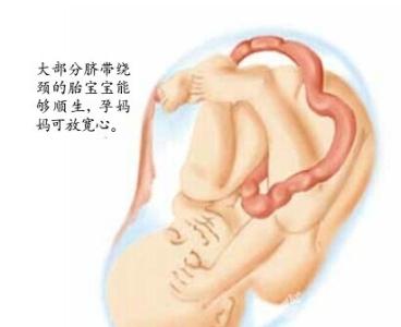 孕妇脐带绕颈怎么办 孕妇如何应对脐带绕颈