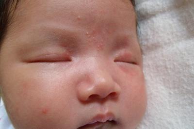 潮湿宝宝容易得湿疹 宝宝的哪些情况容易出现湿疹