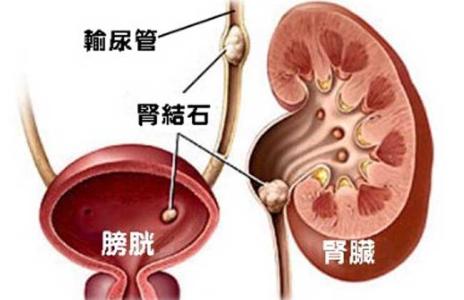 肾结石不能吃什么 肾结石怎样形成的