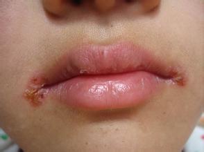 烂嘴角的治疗方法 烂嘴角的治疗方法有哪些 烂嘴角缺乏什么